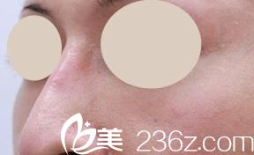 日本品川美容外科外科醫(yī)院的上田寬醫(yī)生拯救了我的鷹鉤鼻!