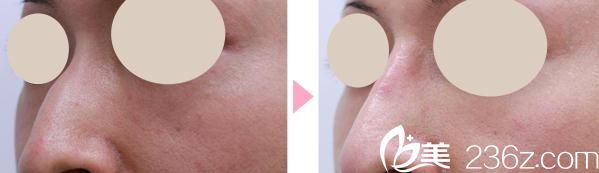 上田寬鼻骨削除手術前后對比