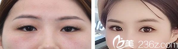 白圣佑醫(yī)生做全切雙眼皮效果案例