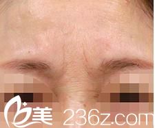 小池康弘瘦臉除皺祛皺前 小池康弘瘦臉除皺祛皺前