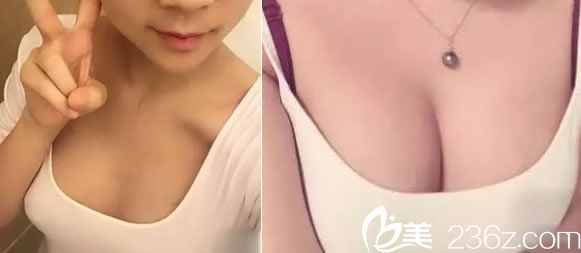 寧波建國整形馬越波自體脂肪隆胸<span style=