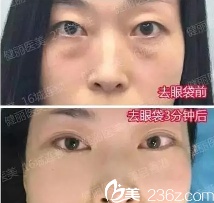 去眼袋手術多少錢？成都健麗醫(yī)美去眼袋案例效果及整形價格表大放送