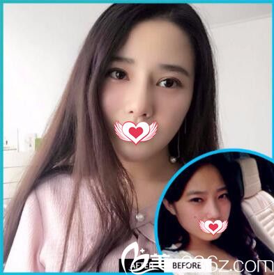 元生態(tài)雙眼皮真人前后效果對(duì)比