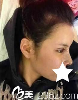 我在韓國青春整形做雙眼皮+隆鼻術(shù)后10天圖