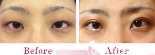 森上和樹雙眼皮手術(shù)前后對(duì)比 森上和樹雙眼皮手術(shù)前后對(duì)比