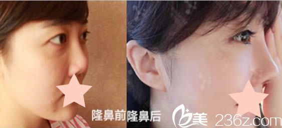 北京米蘭柏羽麗都醫(yī)療美容曹衛(wèi)華鼻綜合隆鼻案例圖 北京米蘭柏羽麗都醫(yī)療美容曹衛(wèi)華鼻綜合隆鼻案例圖