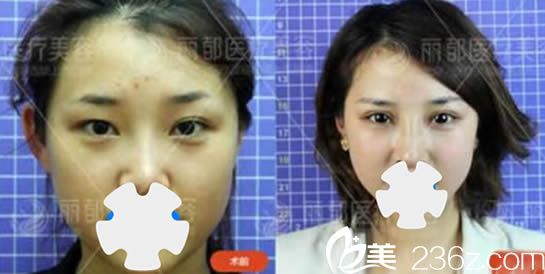 北京米蘭柏羽麗都整形美容醫(yī)院雙眼皮案例效果圖 北京米蘭柏羽麗都整形美容醫(yī)院雙眼皮案例效果圖