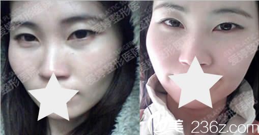 我在韓國愛婷整形醫(yī)院面部整形術(shù)前照 我在韓國愛婷整形醫(yī)院面部整形術(shù)前照