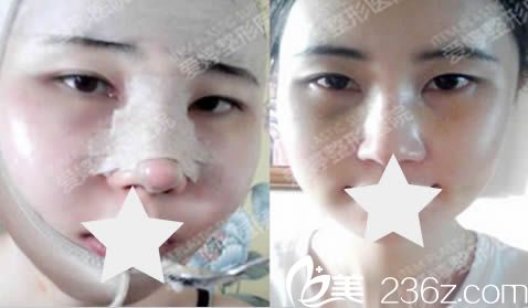 韓國愛婷整形隆鼻+磨顴骨術(shù)后照 韓國愛婷整形隆鼻+磨顴骨術(shù)后照