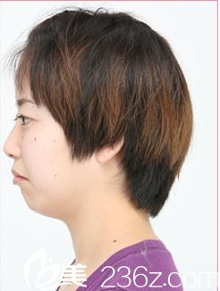 森上和樹注射玻尿酸墊下巴前 森上和樹注射玻尿酸墊下巴前