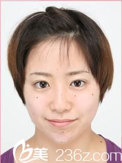 森上和樹注射玻尿酸墊下巴后 森上和樹注射玻尿酸墊下巴后