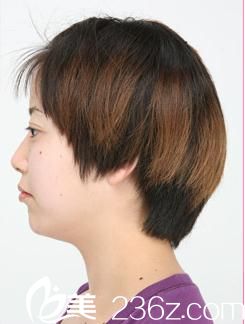 說說我去日本城本整形外科醫(yī)院整形的經(jīng)歷，找森上和樹醫(yī)生為我注射玻尿酸塑下巴