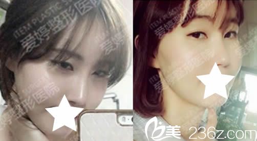 在韓國愛婷看了金振星院長的面部輪廓整形案例后 找他做了隆鼻和磨顴骨及面部脂肪填充