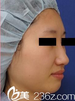 田中真輔隆鼻手術(shù)前