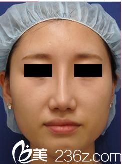 真實案例分享，找日本城本醫(yī)療美容醫(yī)院的田中真輔醫(yī)生給我做的硅膠假體隆鼻