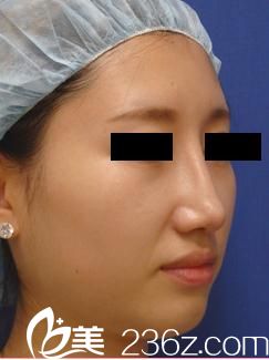 田中真輔隆鼻手術(shù)后