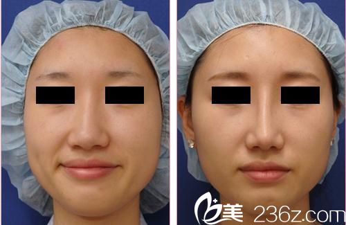 田中真輔隆鼻手術(shù)前后對(duì)比