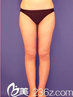 如何瘦大腿?日本城本醫(yī)療美容醫(yī)院的小川英朗為我做了大腿吸脂，讓我告別了大象腿