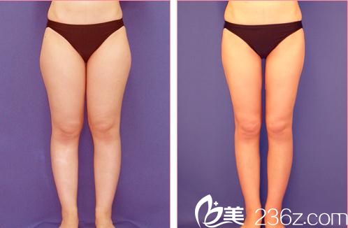 小川英朗吸脂手術(shù)前后對(duì)比