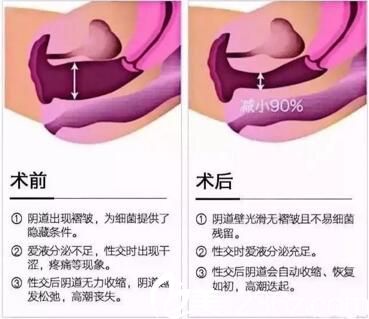 雅美櫻花私密煥活術(shù)術(shù)前術(shù)后變化效果