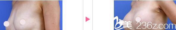 中村大輔豐胸手術(shù)前后對(duì)比 中村大輔豐胸手術(shù)前后對(duì)比
