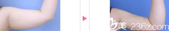 中村大輔手臂吸脂手術(shù)前后對比 中村大輔手臂吸脂手術(shù)前后對比