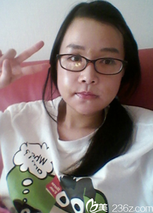 韓國原辰整形醫(yī)院vline瓜子臉手術前期 韓國原辰整形醫(yī)院vline瓜子臉手術前期