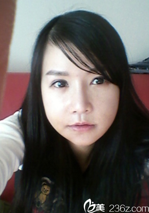 韓國原辰整形醫(yī)院vline瓜子臉手術術后6天 韓國原辰整形醫(yī)院vline瓜子臉手術術后6天