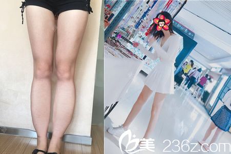 嘉興藝星張占召小腿吸脂案例