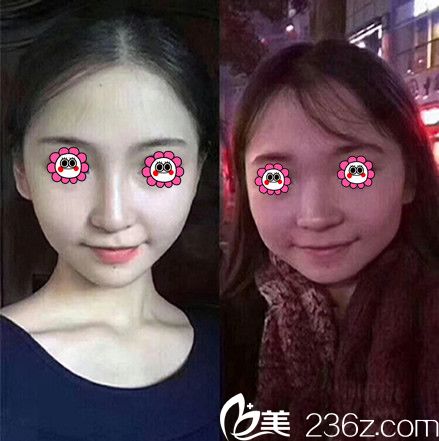 夢(mèng)露整形醫(yī)院游萬(wàn)福主任隆鼻效果圖