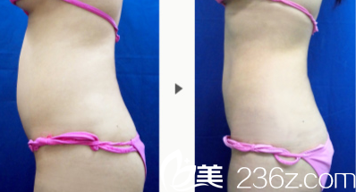 長大庭英信吸脂手術(shù)