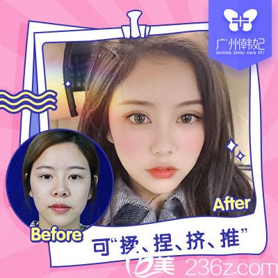 廣州韓妃劉志剛隆鼻案例