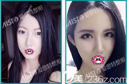 整形醫(yī)院雙眼皮前后對比圖 整形醫(yī)院雙眼皮前后對比圖