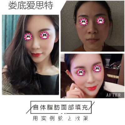 愛思特自體脂肪填充變化圖 愛思特自體脂肪填充變化圖