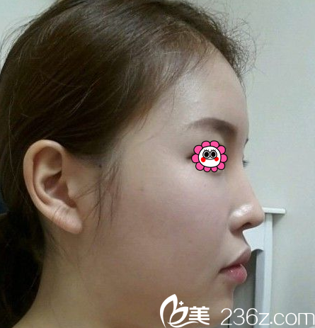 在北京畫美做面部吸脂前樣子 在北京畫美做面部吸脂前樣子