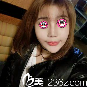 趙宏偉醫(yī)生給我做面部吸脂第26天<span style= 趙宏偉醫(yī)生給我做面部吸脂第26天<span style=