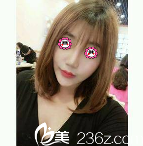 在北京畫美做面部吸脂第48天樣子 在北京畫美做面部吸脂第48天樣子