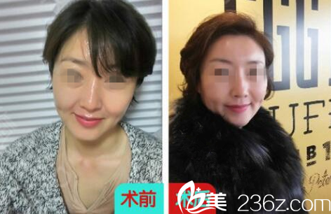 長(zhǎng)春東方面部線雕提升案例 長(zhǎng)春東方面部線雕提升案例