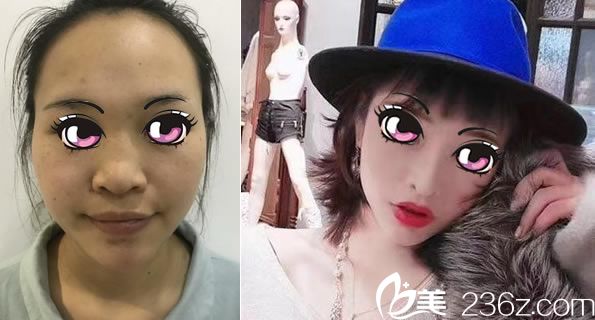 徐一波肋軟骨鼻綜合案例 徐一波肋軟骨鼻綜合案例