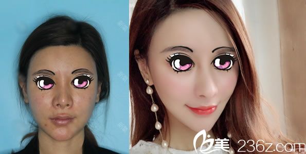 徐一波做鼻失敗修復(fù)案例 徐一波做鼻失敗修復(fù)案例