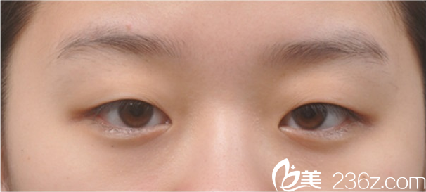 韓國新帝瑞娜(灰姑娘)醫(yī)院眼提肌+雙眼皮+前眼角術(shù)前 韓國新帝瑞娜(灰姑娘)醫(yī)院眼提肌+雙眼皮+前眼角術(shù)前