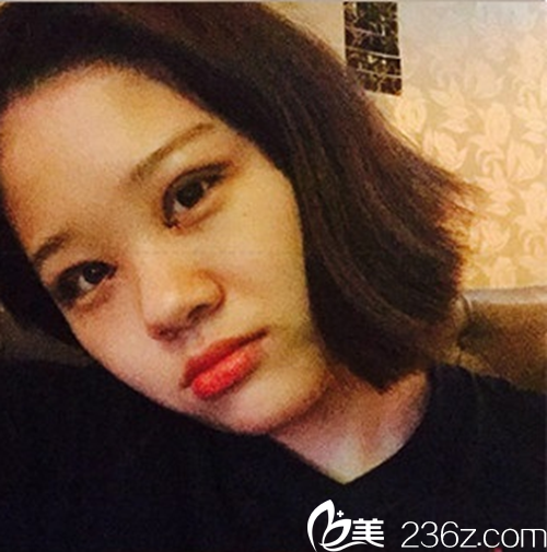 韓國新帝瑞娜(灰姑娘)醫(yī)院眼提肌+雙眼皮+前眼角術(shù)后2-10天 韓國新帝瑞娜(灰姑娘)醫(yī)院眼提肌+雙眼皮+前眼角術(shù)后2-10天