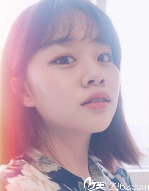 韓國新帝瑞娜(灰姑娘)醫(yī)院眼提肌+雙眼皮+前眼角術(shù)后3個月 韓國新帝瑞娜(灰姑娘)醫(yī)院眼提肌+雙眼皮+前眼角術(shù)后3個月