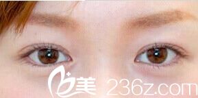 日本雙眼皮整形之旅,看日本大冢整形醫(yī)院的石井秀典醫(yī)生為我做的埋線雙眼皮