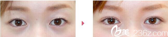 石井秀典埋線雙眼皮前后對(duì)比