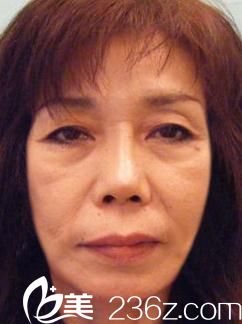 日本臉型整形醫(yī)院---在日本大冢整形醫(yī)院找佐藤大介做的面部大拉皮,讓我改頭換面!