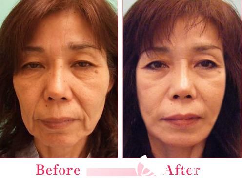 佐藤大介拉皮手術(shù)前后對(duì)比