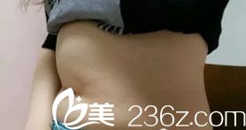 在衡水天宏做腰腹吸脂術前腰部肥胖 在衡水天宏做腰腹吸脂術前腰部肥胖