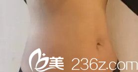 衡水天宏楊輝醫(yī)生做腰腹吸脂18天后已經(jīng)消腫 衡水天宏楊輝醫(yī)生做腰腹吸脂18天后已經(jīng)消腫