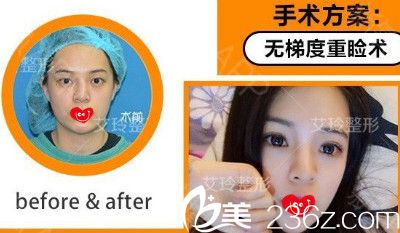 唐山艾玲年末整形優(yōu)惠享不停 現(xiàn)在做雙眼皮和吸脂只需1980元、8800元